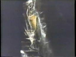 Silent Scream 1980 TV trailer