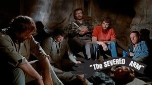 The Severed Arm